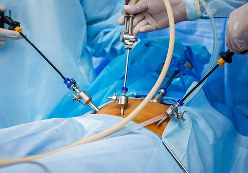 laparoscopy-surgery-500x500