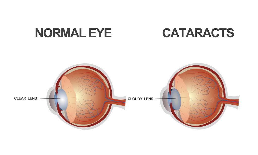 Cataract: 7 Tips To Prevent Your Eyes From