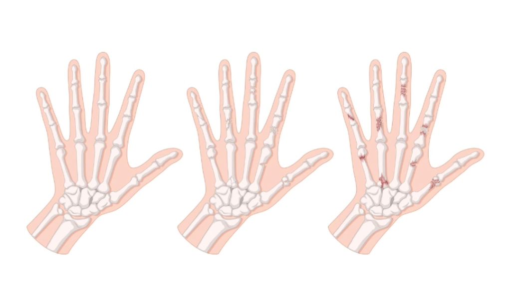 Types Of Fracture