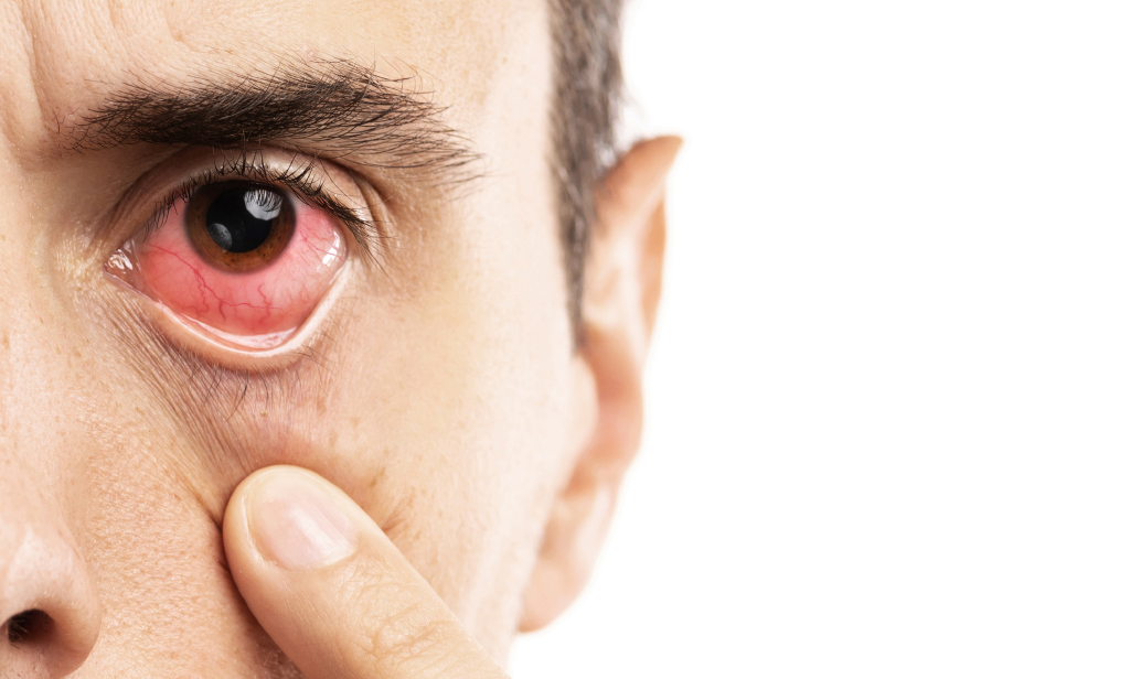 Pink Eye Causes And Treatments