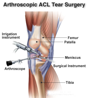 What Is Arthroscopy And When Do We Need It?