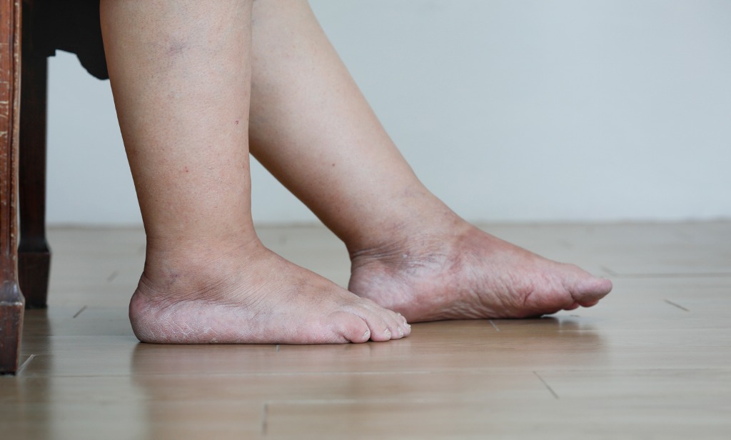 9 Reasons For Swollen Foot